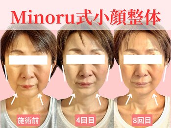 フレキシボディ(FlexiBody)/小顔施術ビフォーアフター #3