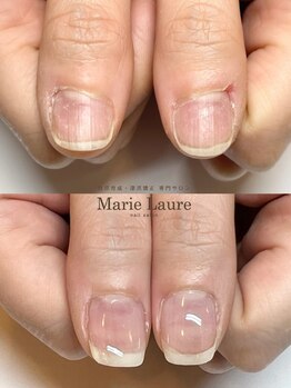 マリーロール 梅田店(Marie Laure)/自爪育成/深爪矯正/ネイルケア
