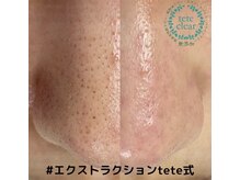 エクレ(eclat)/毛穴エクストラクションtete式