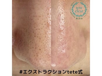 エクレ(eclat)/毛穴エクストラクションtete式