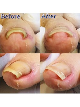 巻き爪補正店 湘南辻堂店/巻き爪・補正例