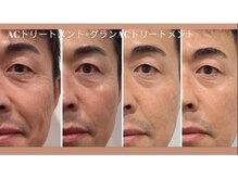 ララ(LARA)の雰囲気（羊水幹細胞をエアジェット導入◎たるみケア＆美肌&リフトアップ）