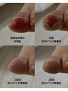 巻き爪補正の経過記録(左母趾)