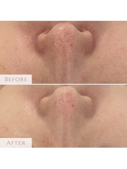 ミエル 神戸店(Miel)/エレクトロポレーション