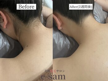 イーサム 高槻摂津富田店(e-sam)/丸ごと全身脱毛