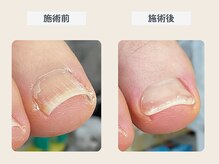 ルポ 伊勢/巻き爪ケア