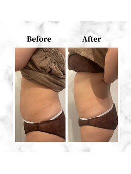 ザビューティー 麻布十番本店(The Beauty)/12Dリフトお腹美くびれ[リフト]