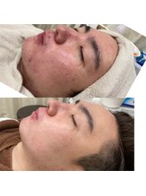 ラルーナ(La Luna)/ハーブピーリング★