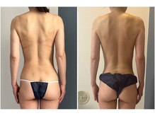 モア(moa)/50代女性　4回目桃尻に