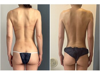 モア(moa)/50代女性　4回目桃尻に