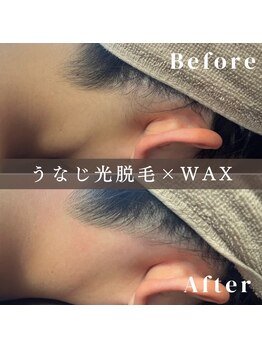 エピナ 横浜店(Epina)/before&after★うなじ/MIX脱毛