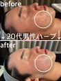 ヒュッゲサロン(HYGGE Salon)&nbsp;【20代男性】ハーブでニキビ跡の改善！男性の肌質改善にも◎