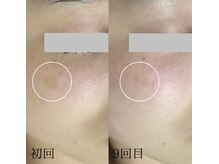 サロンドジェシカ(salon de Jessica)/プラズマ＋ハーブピーリング