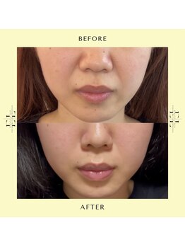 リリィココ(Lily coco.)/ExoLift/エクソリフト