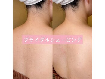 リンド エステ まつげ 京成大久保(Lind)/ブライダルシェービング