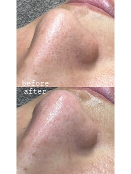 プラスボーテ 幡ヶ谷(plus beaute)/毛穴エクストラクション/原宿