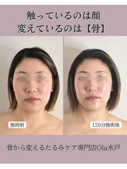 オラ(Ola)/30代/1回目施術後