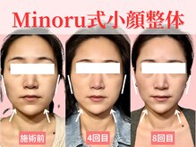 フレキシボディ(FlexiBody)/小顔施術ビフォーアフター #4