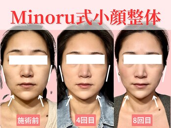 フレキシボディ(FlexiBody)/小顔施術ビフォーアフター #4