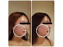 サロン ポム(salon pom)の雰囲気(美容術後ケアもインディバでむくみ、ぼこつき、ひきつれ感軽減!)