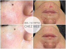 シェミー(CHEZ MEE)の雰囲気（徹底的に毛穴改善◎繰り返す頑固なニキビや肌荒れもリセット！）