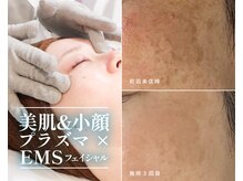 ルポ 鶴見(Repos)/【プラズマ×EMS小顔】3回