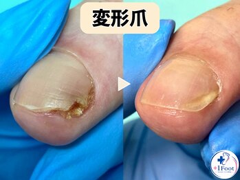 プラスワンフット 本厚木(+1 Foot)/変形・肥厚した爪を正常な爪へ