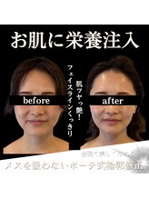 クリニカルボーテ 心斎橋院(CLINICAL BEAUTE)/小顔だけじゃない美肌も一緒に