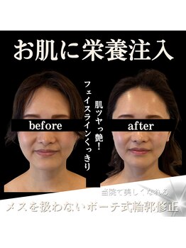 クリニカルボーテ 心斎橋院(CLINICAL BEAUTE)/小顔だけじゃない美肌も一緒に
