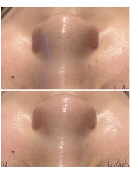 プレジール(plasir)/毛穴の黒ずみがここまで綺麗に!