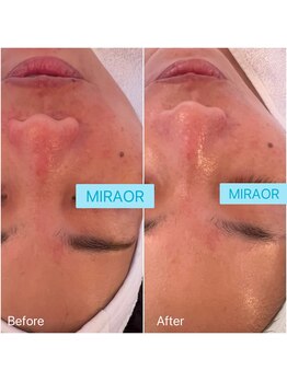 ミラー(MIRAOR)/クリスティーナ/アンストレス3回