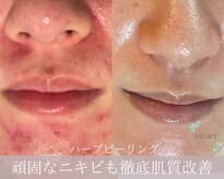 ストーリー(STORY)