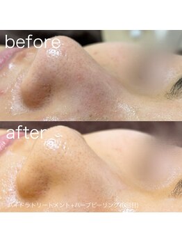 ルルラ リコ(lulula rico)/症例写真/ハイドラ毛穴洗浄