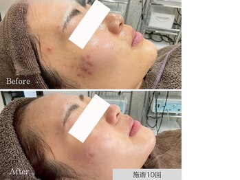 ニキビ研究所 千葉店/頬からフェイスラインニキビケア