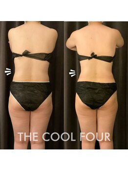 クライオ360(Cryo360)/脂肪冷却ビフォーアフター