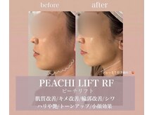 ナビ(NAVI)/韓国最新リフトアップ機械！