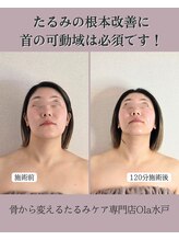 オラ(Ola)/30代/1回目施術後