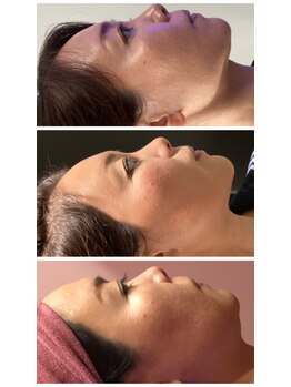 プラチナアース つくば店(Platinum earth)/フェイシャルビフォーアフター