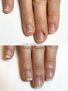 マリーロール 梅田店(Marie Laure)/自爪育成/深爪矯正/ネイルケア
