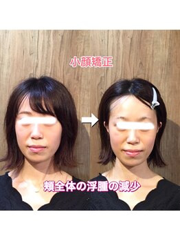 ハリス(HARIS)/お顔全体のむくみ減少