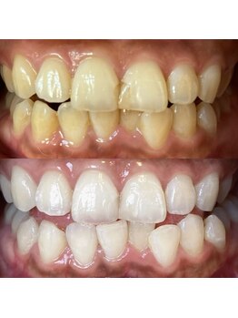 ワールドビューティー(World Beauty)/ブライダルホワイトニング