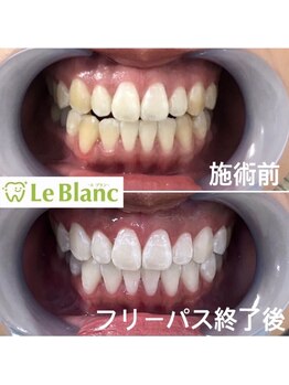 ルブラン 奈良店(Le Blanc)/納得の歯に!