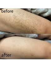 ヴィシアス(VIXIAS)/脱毛　施術1回　1ヶ月後