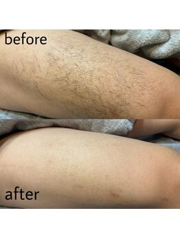 ヴィシアス(VIXIAS)/脱毛　施術1回　1ヶ月後