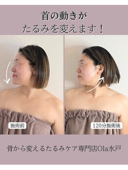 オラ(Ola)/30代/1回目施術後