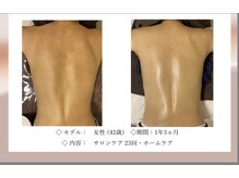 エテル(eter)の雰囲気（エクスビアンスボディピーリング。背中ニキビ、かかと割れに◎）