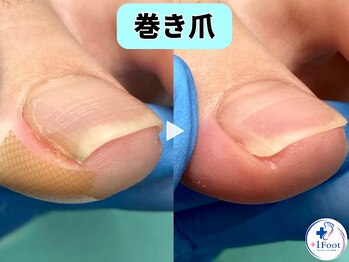 プラスワンフット 本厚木(+1 Foot)/巻き爪矯正は専門店へ●