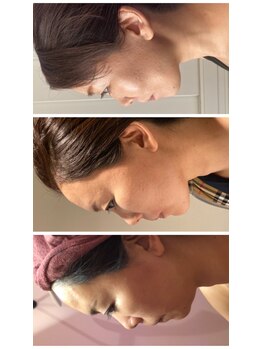 プラチナアース つくば店(Platinum earth)/フェイシャルビフォーアフター