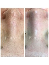 プランス 福岡(PLANCE)/毛穴の黒ずみ／福岡／天神エステ