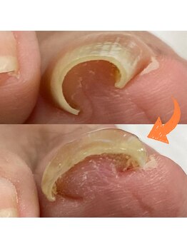 スマートリフト 五反田 大崎店(SMART LIFT)/巻き爪改善施術【大崎/五反田】